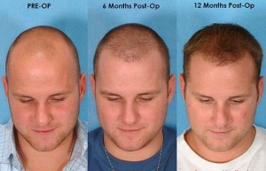 مراحل کاشت مو