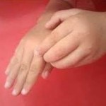 چطور جای نیش پشه را تسکین دهیم؟