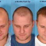 راجع به کاشت مو