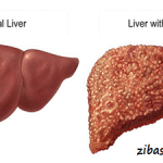 اگر کبد چرب دارید از این میوه ها غافل نشوید