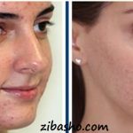 چرا از خوردن قرص راکوتان می ترسید؟