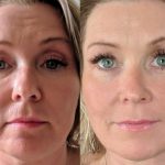 همه آنچه که باید درباره میکرونیدلینگ بدانید