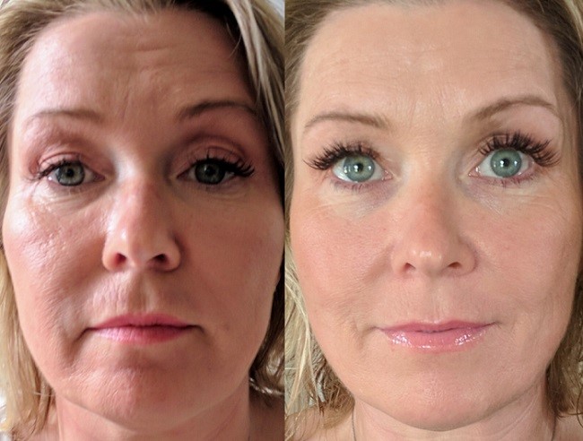 تفاوت شفافیت و زیبایی پوست قبل و بعد از میکرونیدلینگ